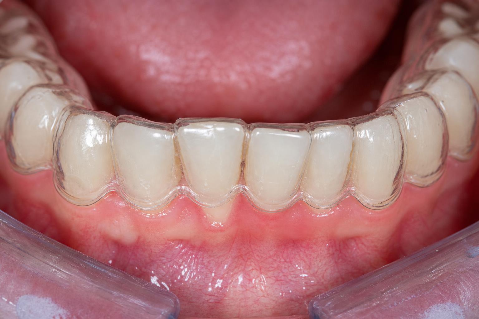 Invisible Braces after