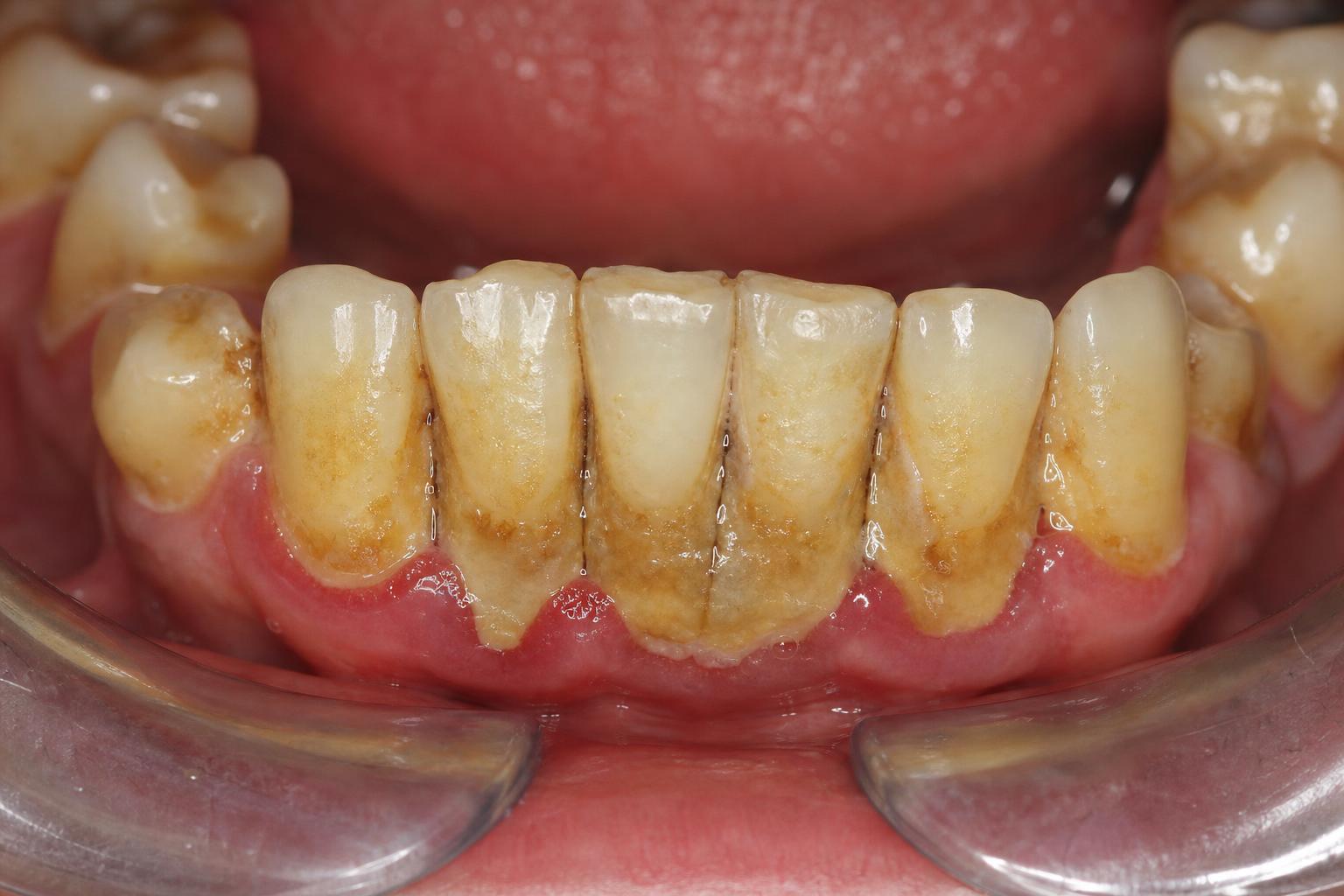Tooth Cleaning before