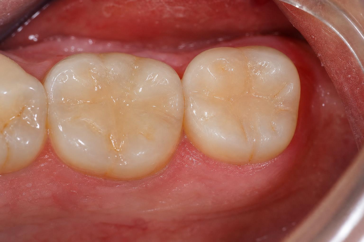 Tooth Colour Fillings after