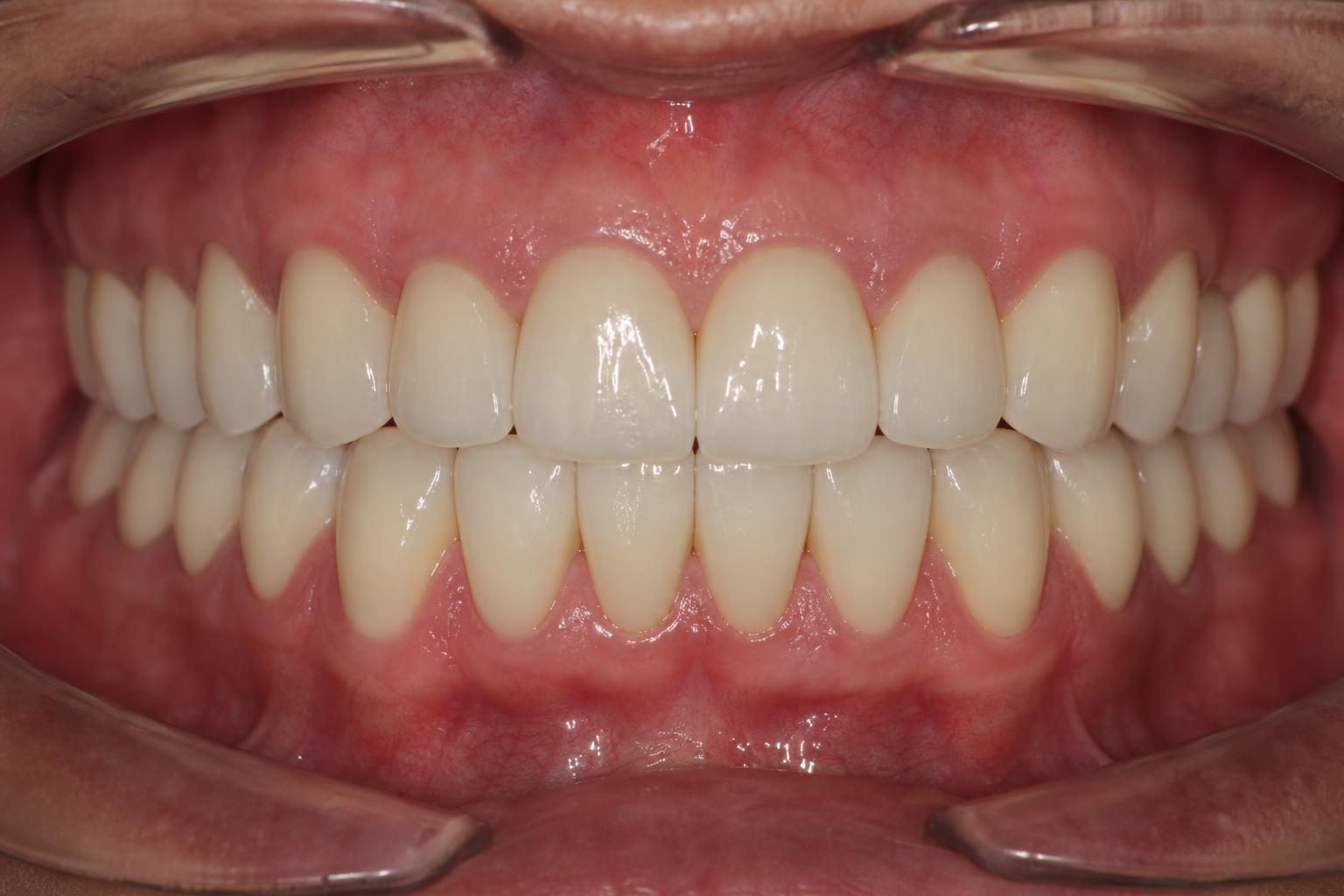 Full Mouth Rehabilitation after