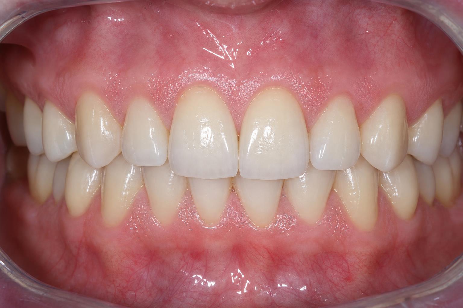 Gum Surgery after