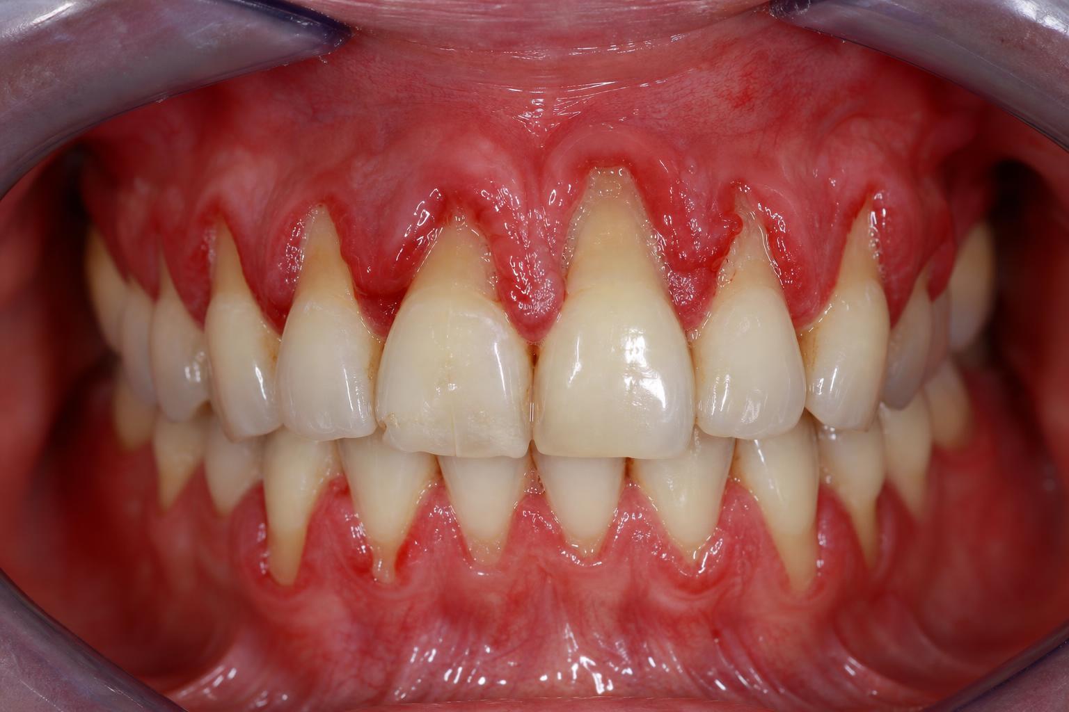 Gum Surgery before
