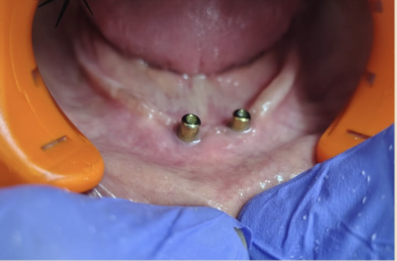 Implant Dentures before