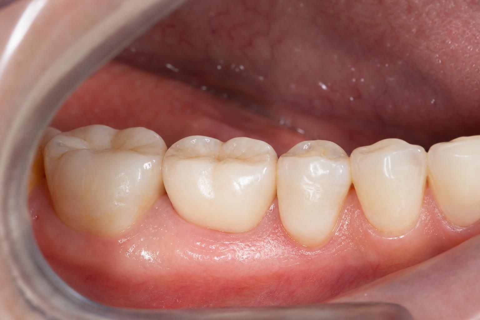 Fixed Dental Implants after