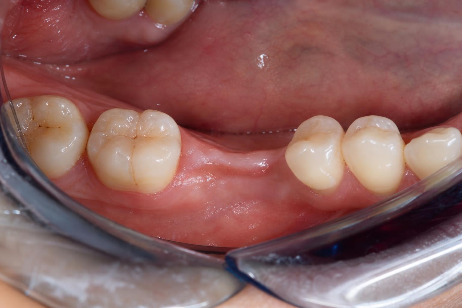 Fixed Dental Implants before