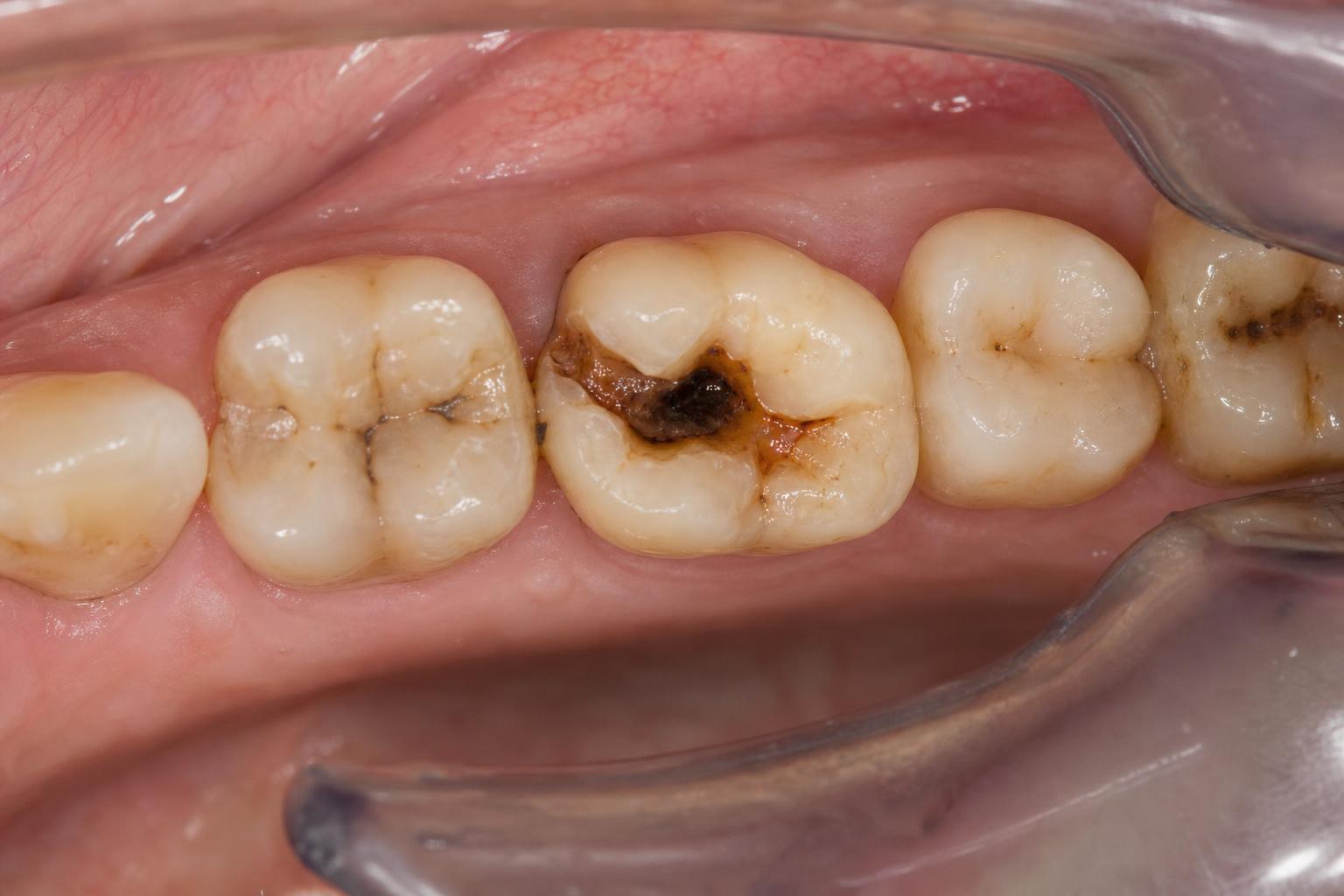 Root Canal Treatment before