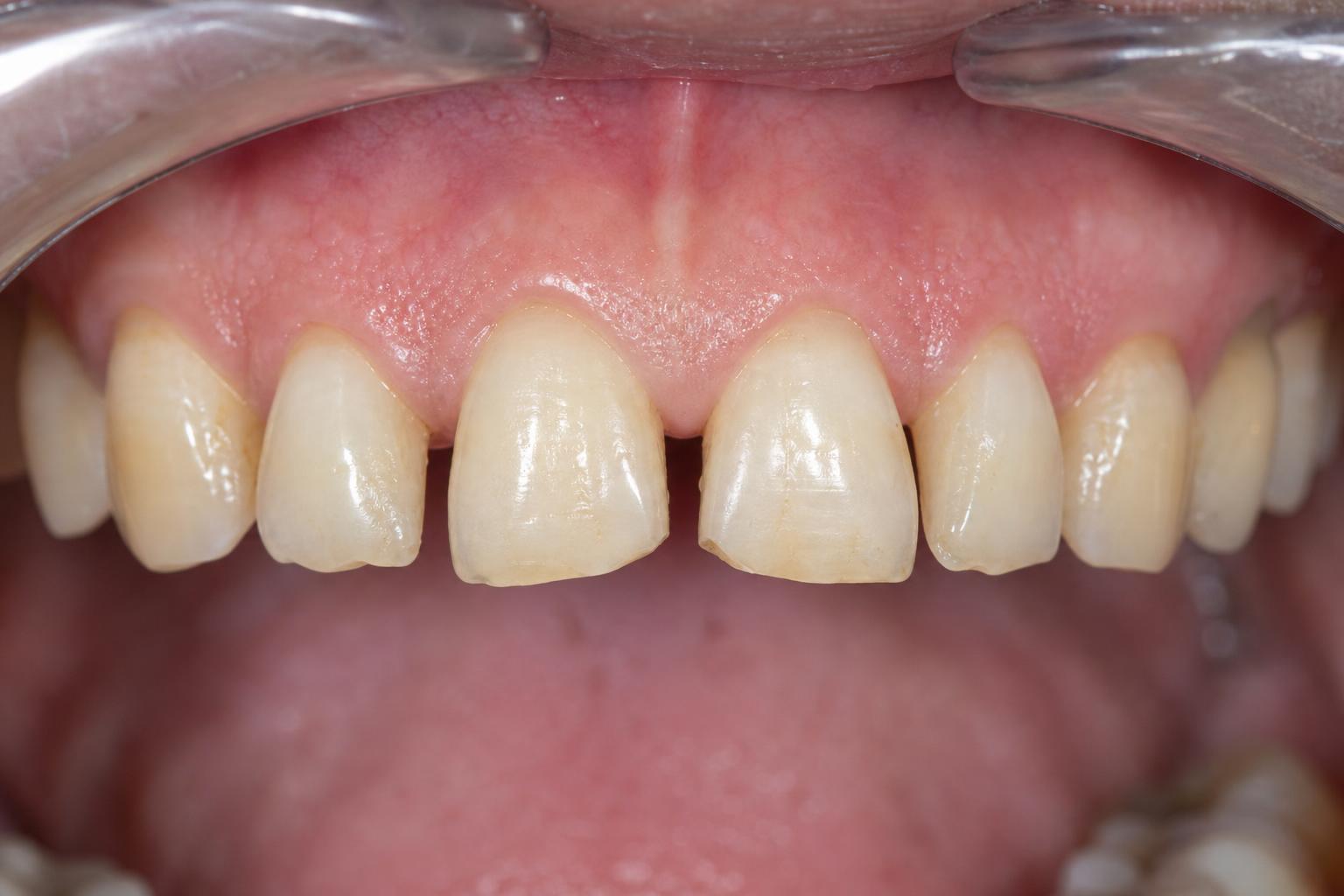 Aesthetic Smile Design before